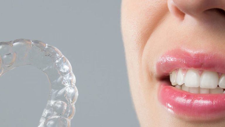 Personne tenant un aligneur transparent devant ses dents