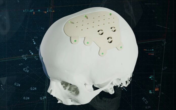 Materialise's new personalized PEEK CMF implant