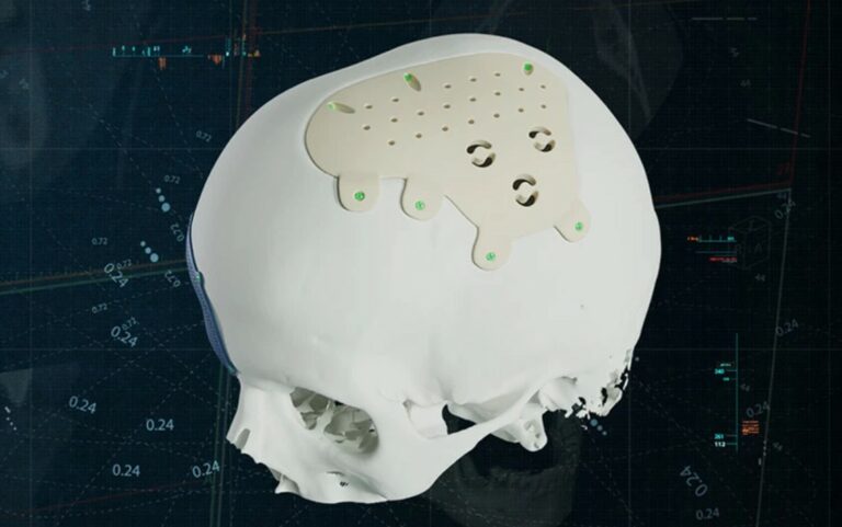 Materialise's new personalized PEEK CMF implant