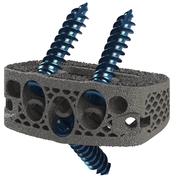 Implant Manufactured from DeGen Medical’s Proprietary Titanium PURI-TI™ Diamond Lattice Structure.