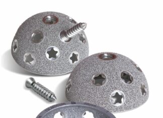 3D-printed titanium hip implant. Courtesy of Smith & Nephew.