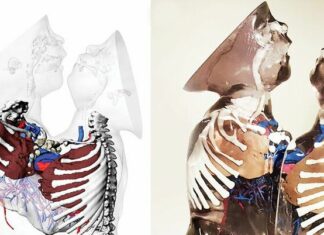 How 3D printing helps separate conjoined twins at Bambino Gesù and what it means for surgical preparation