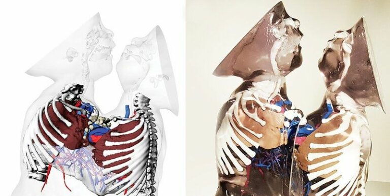 Anatomical models showing the shared thoracic structures of conjoined twins.