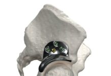 3D printed hip implant