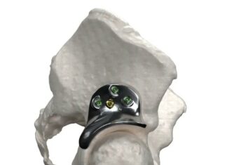 3D printed hip implant