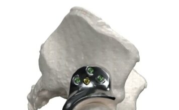 3D printed hip implant