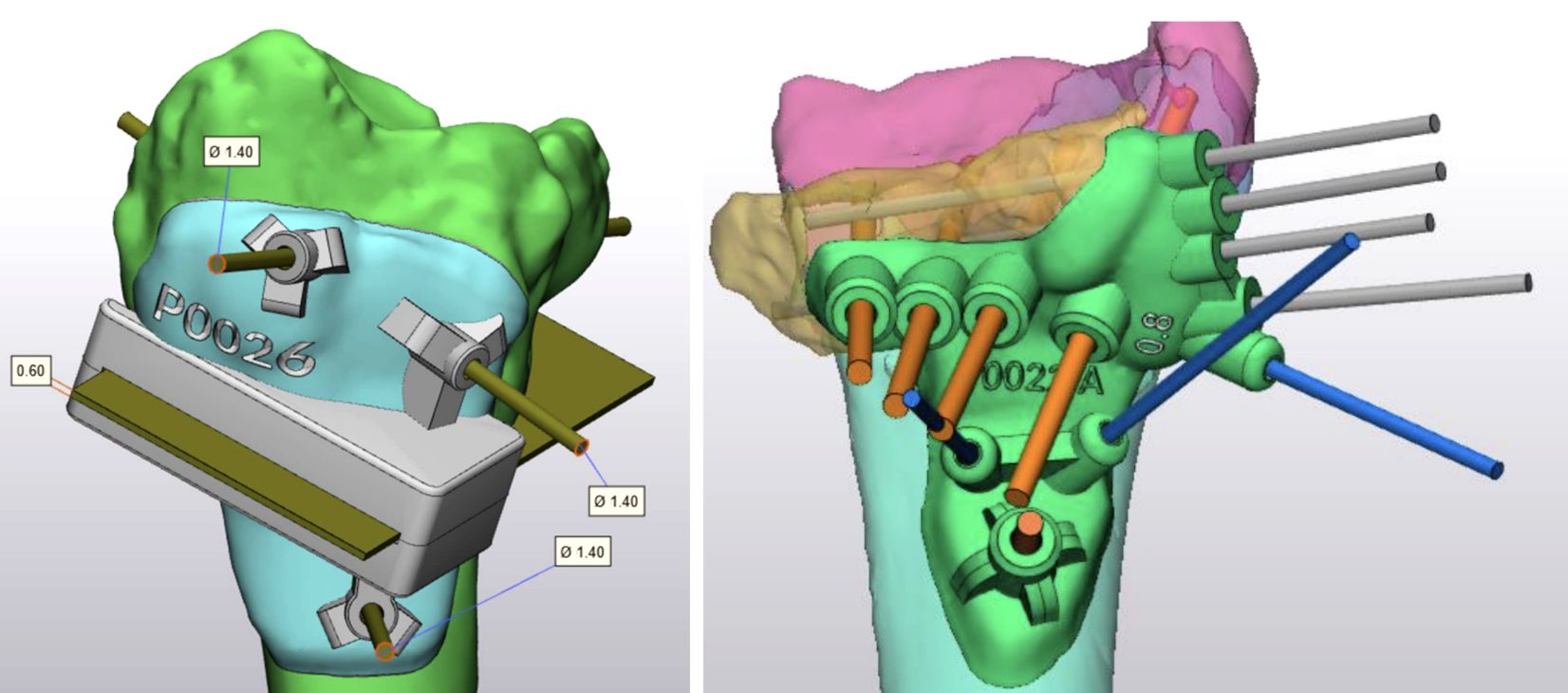 Surgical Cutting Guides for Hand Surgery