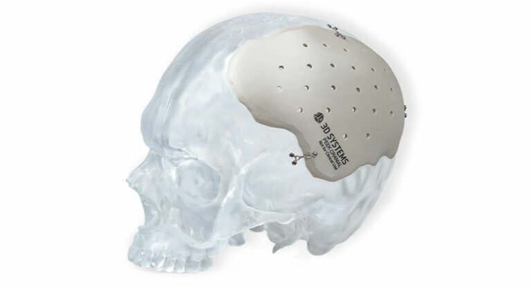 Titanium cranial plate fitted to an anatomical skull model.