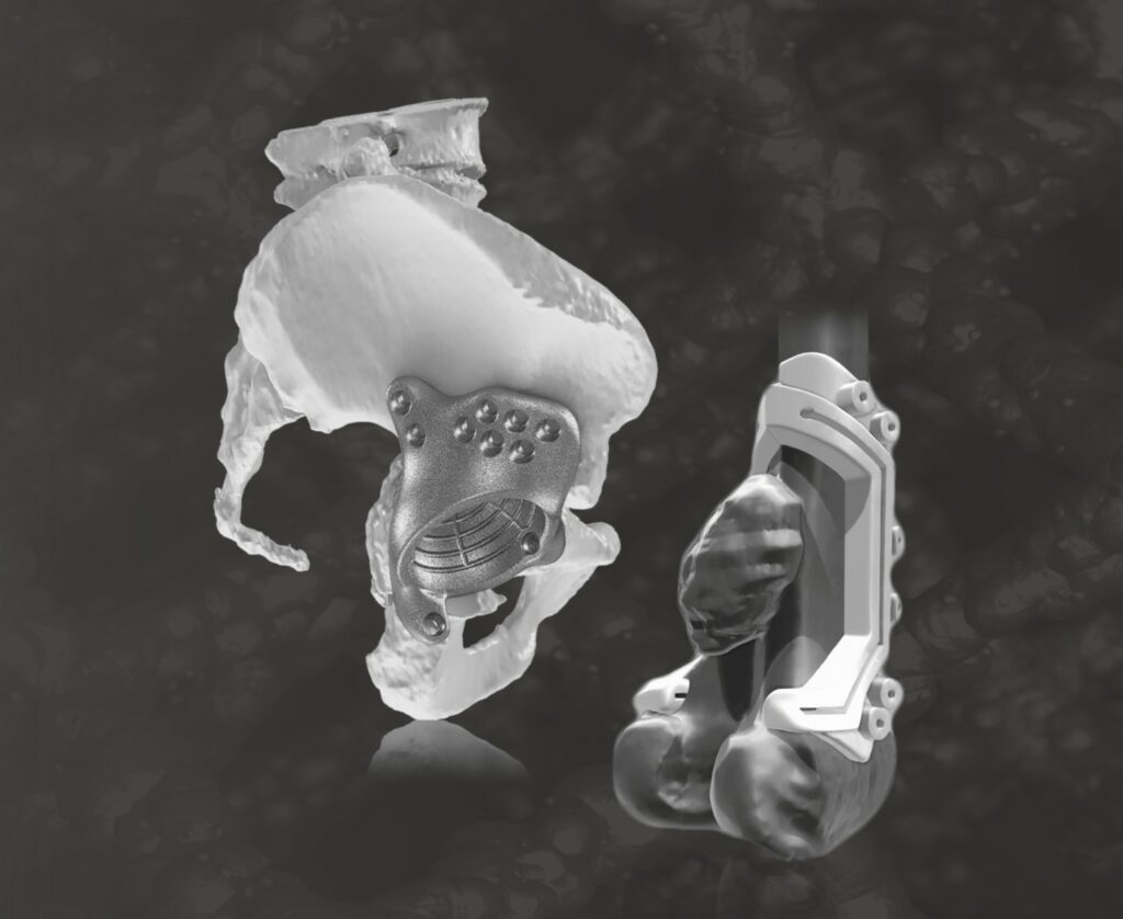 Pelvic anatomical model and patient-specific implant.