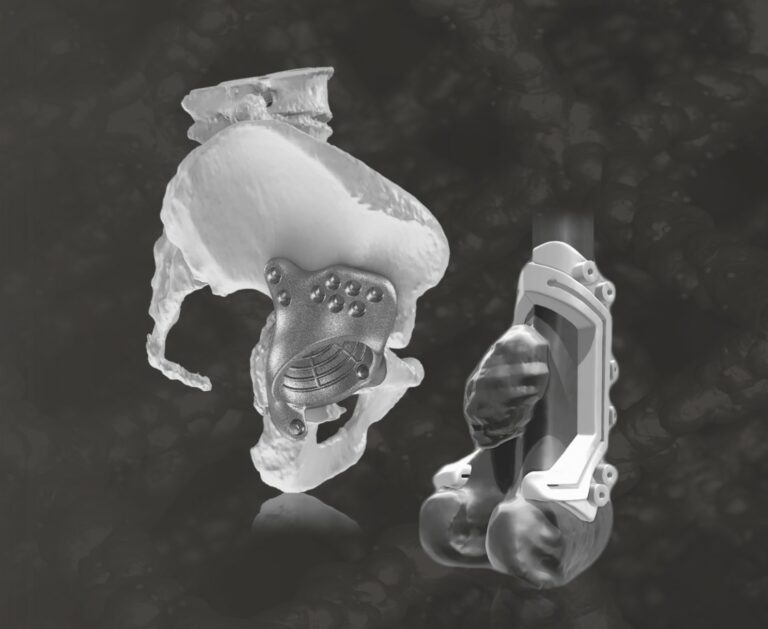 Pelvic anatomical model and patient-specific implant.